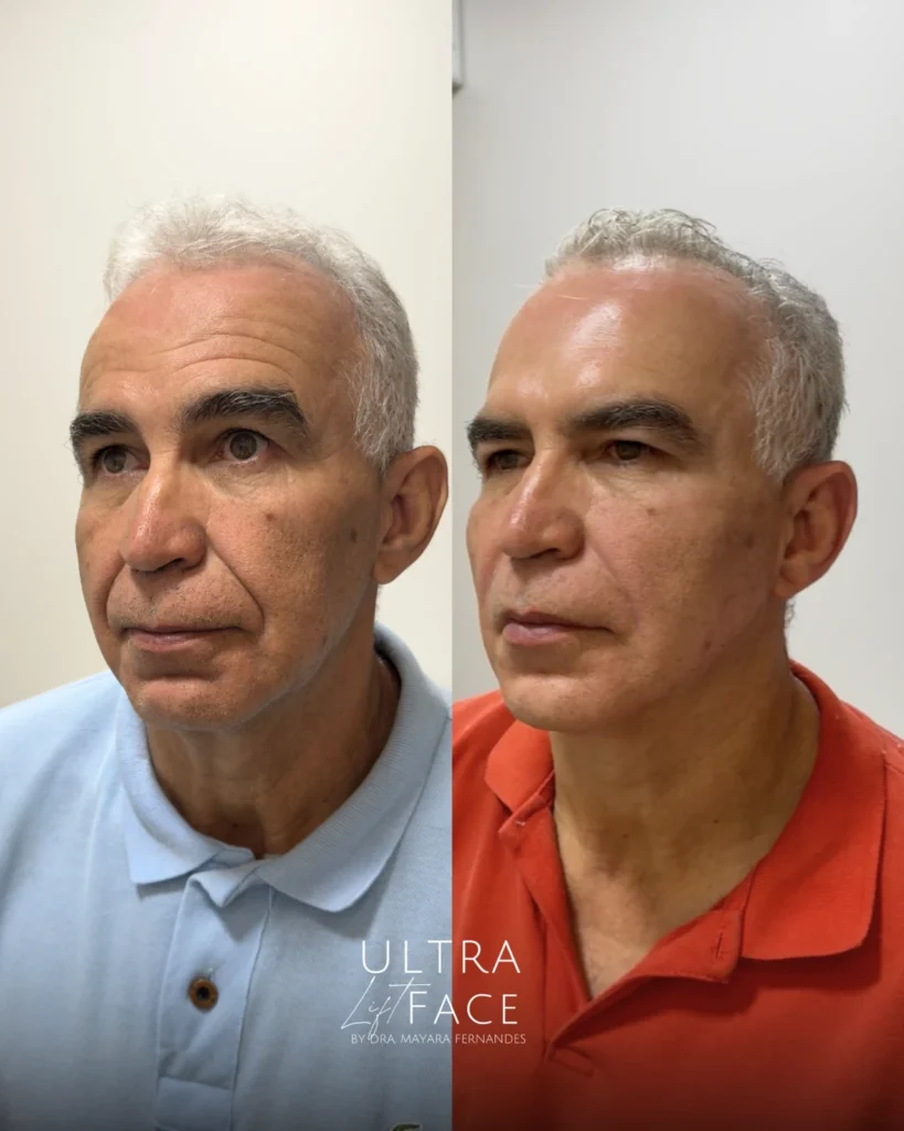 harmonizacao facial