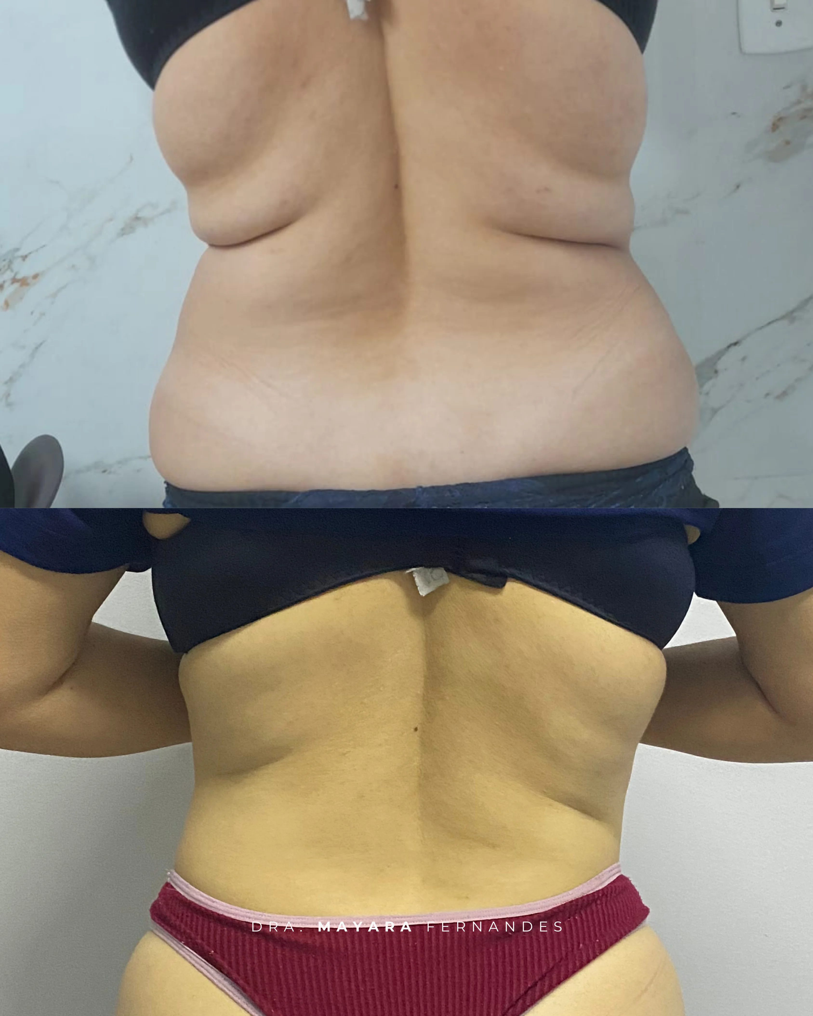 Resultado CrioShape Moriah