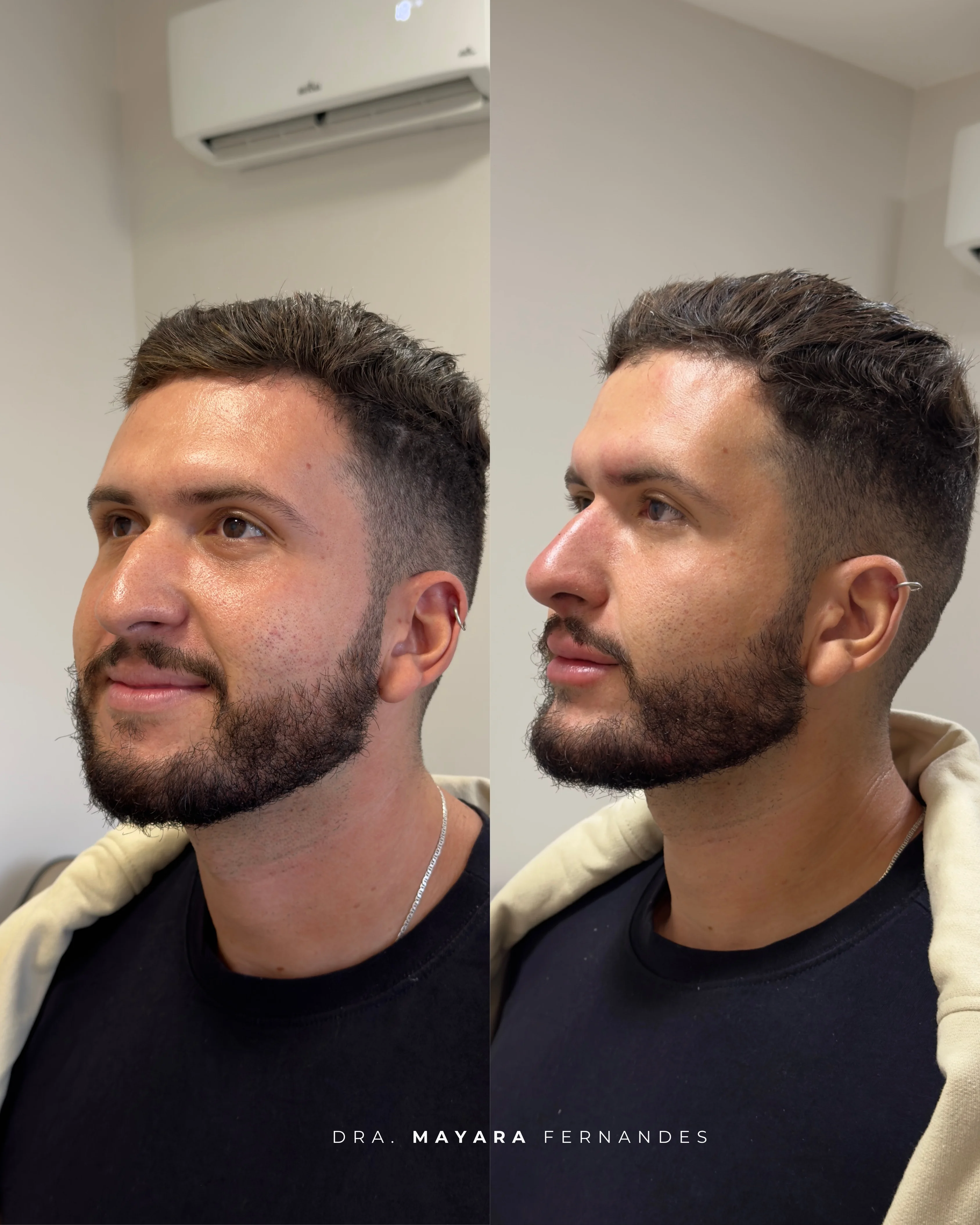 Resultado Harmonização Facial