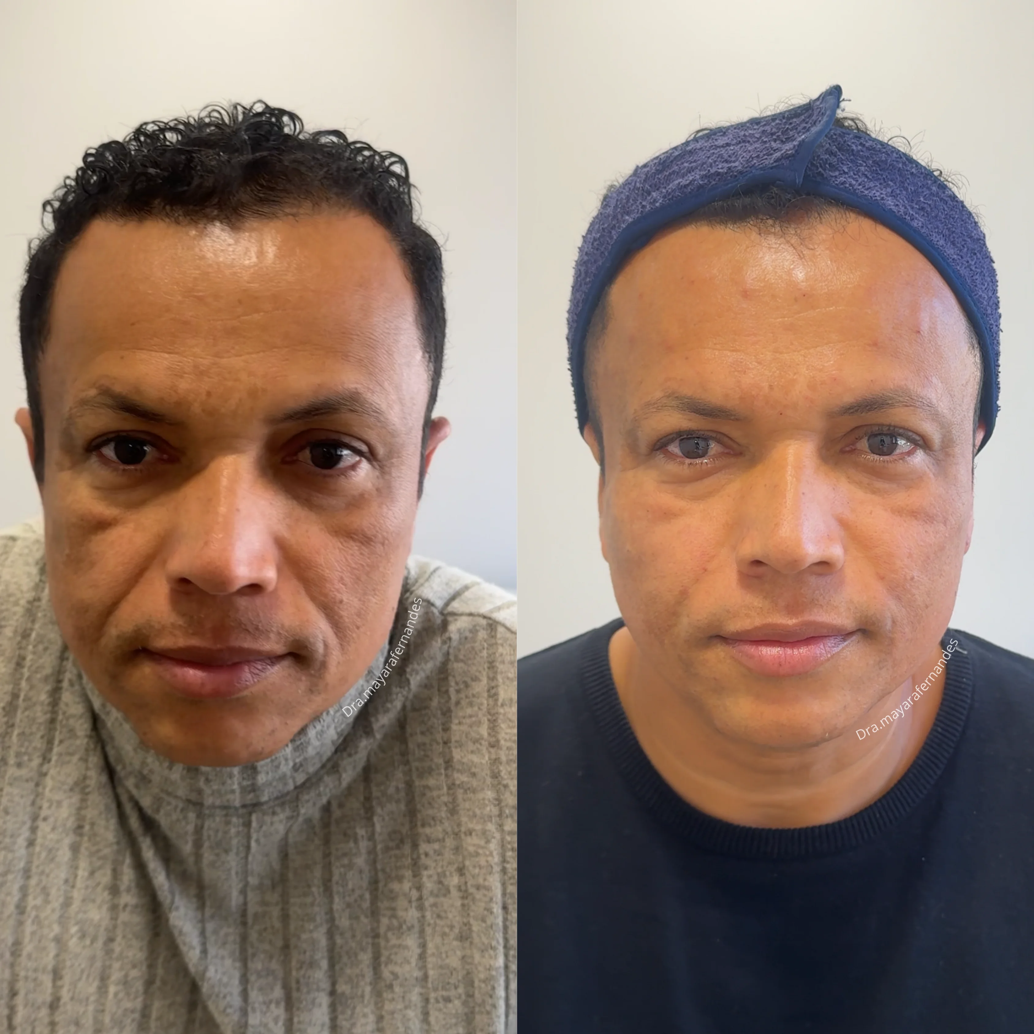 Resultado Harmonização Facial