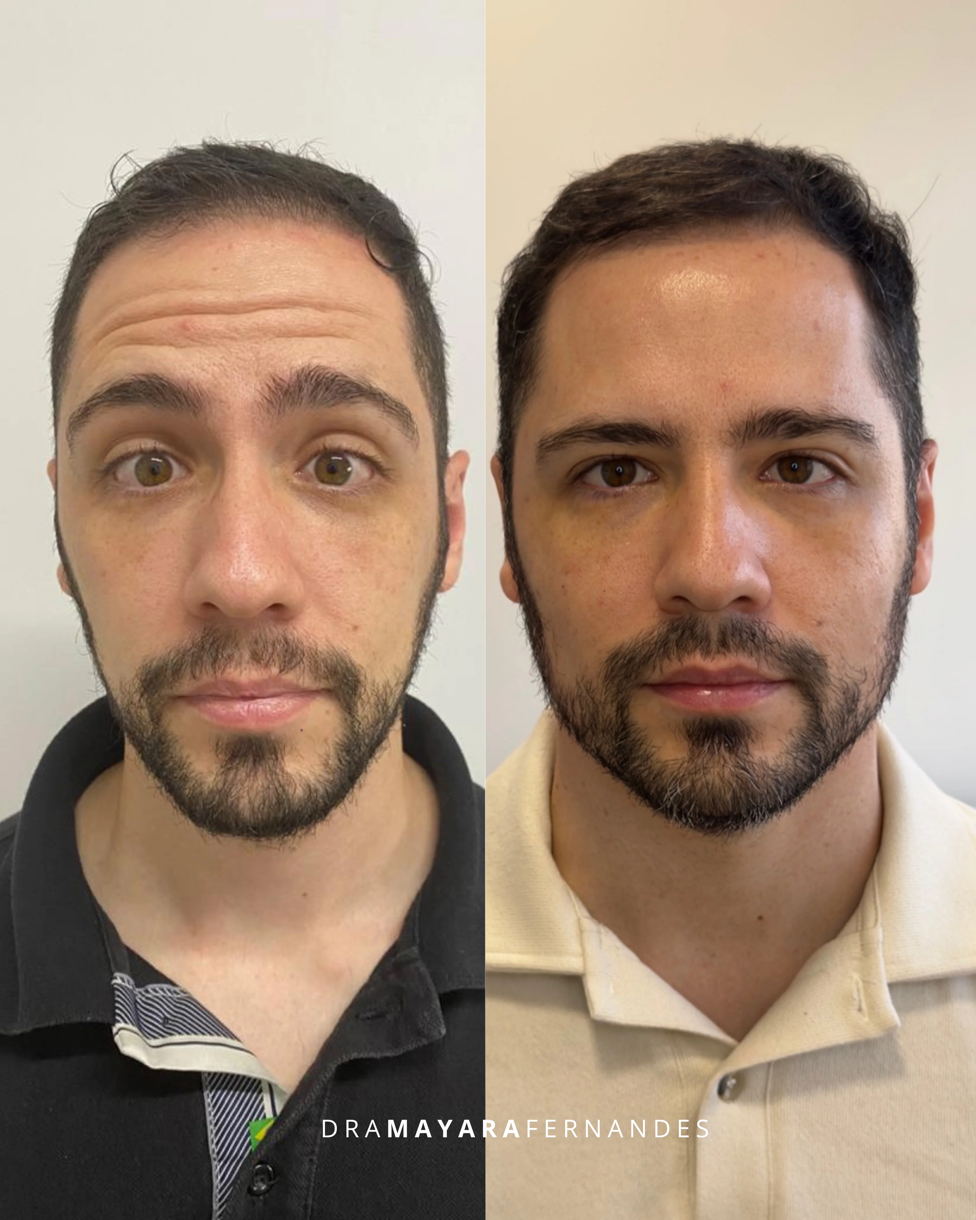 Harmonização Facial