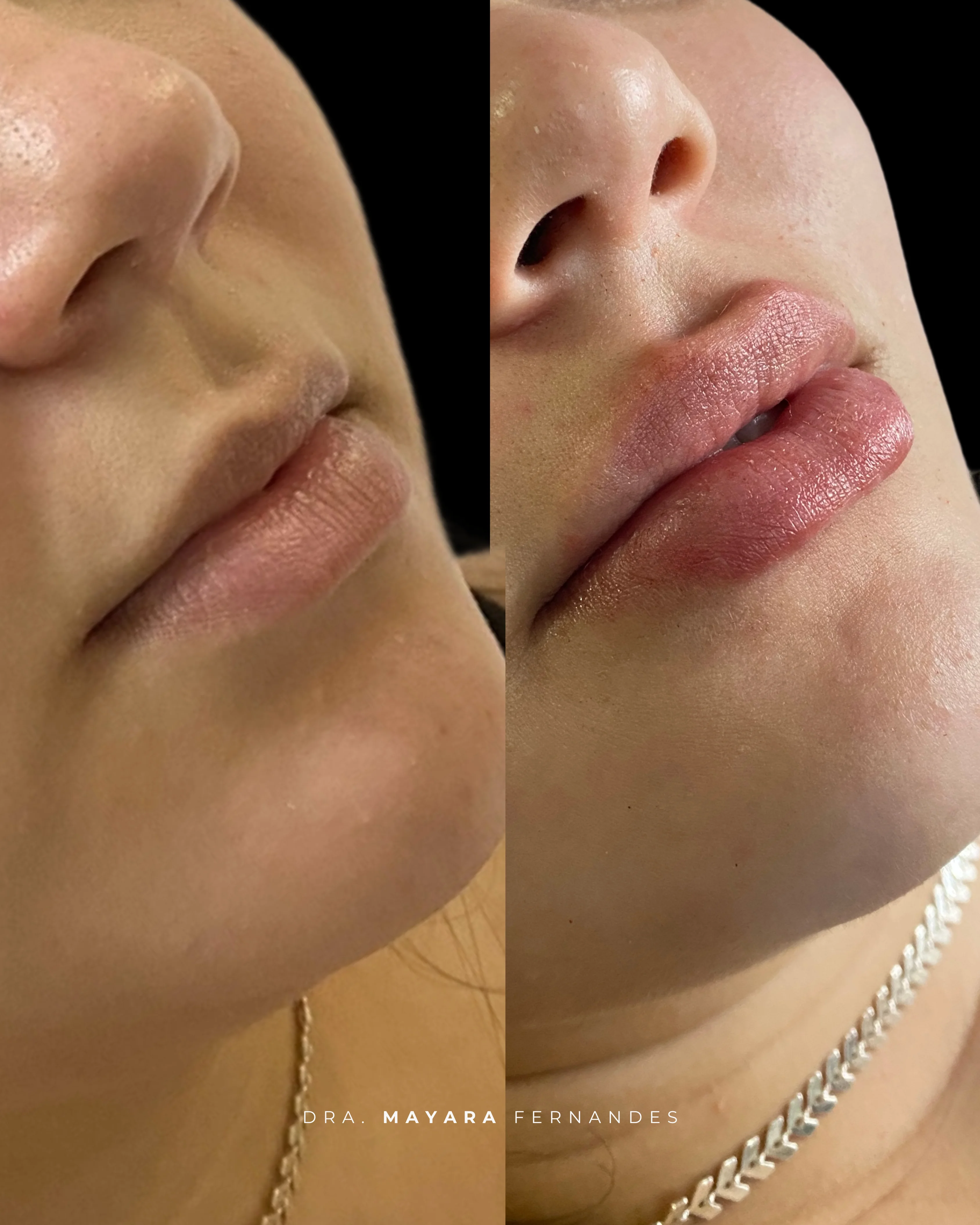 Resultado Preenchimento Labial