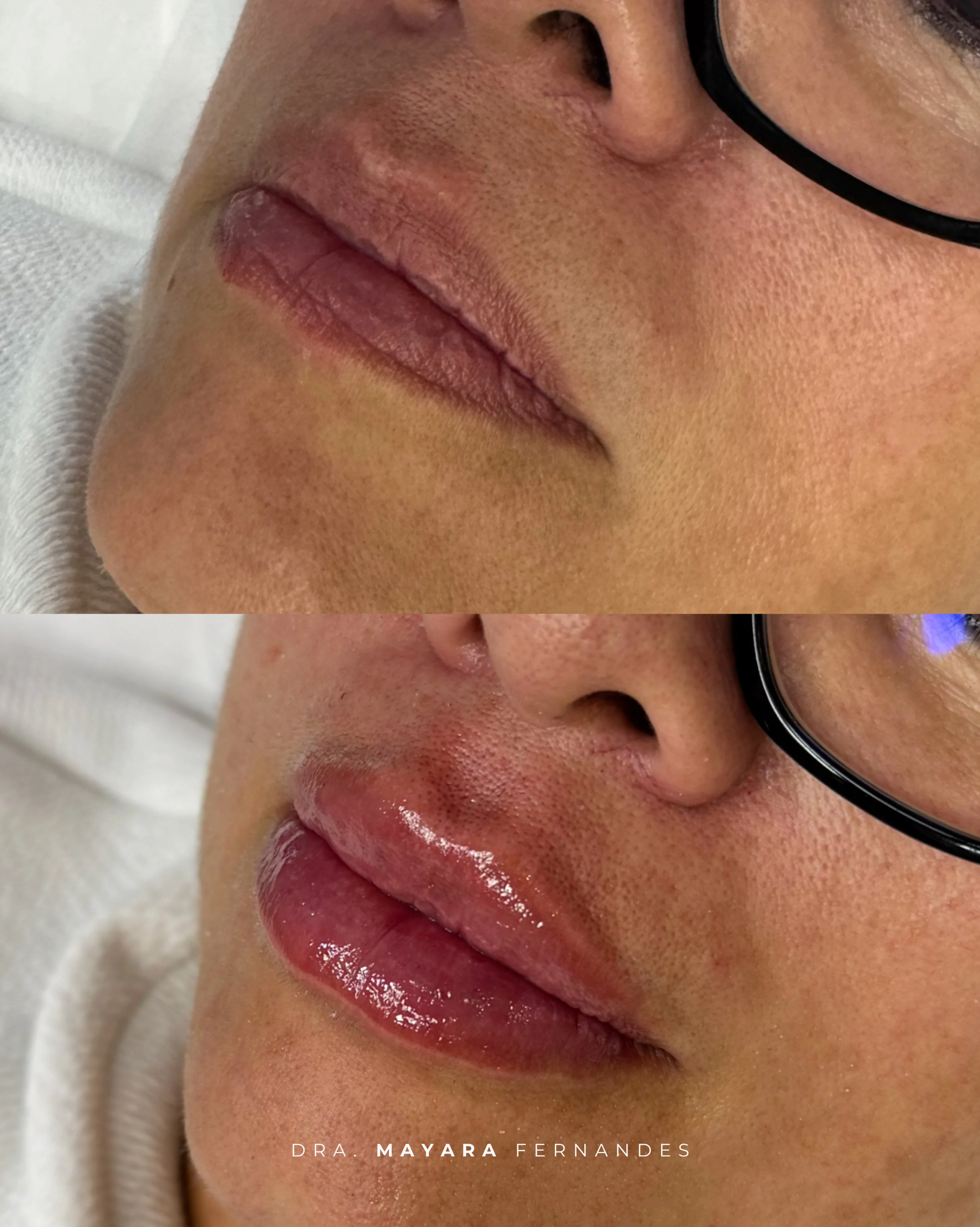 Resultado Preenchimento Labial