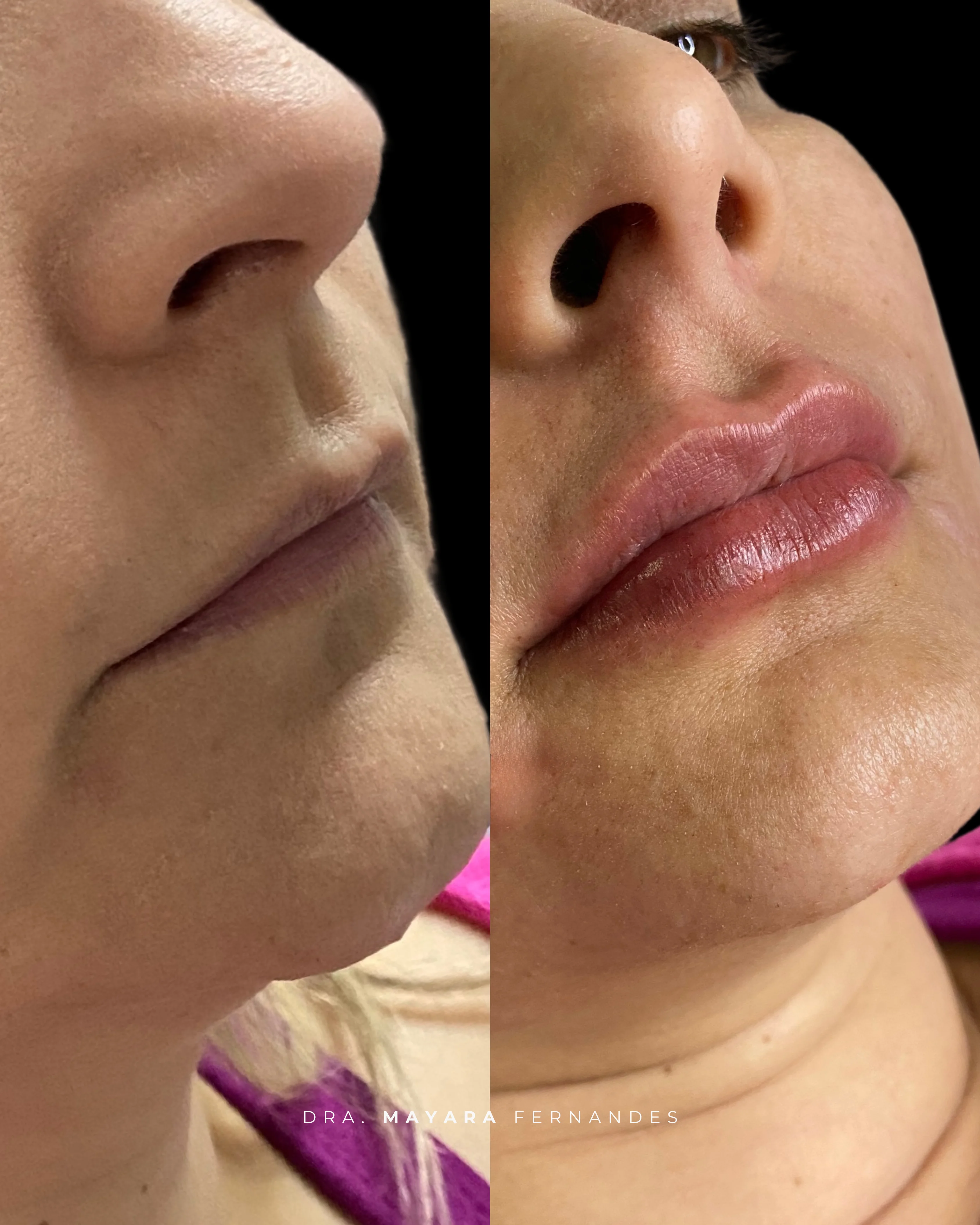 Resultado antes e depois de preenchimento labial Moriah Clínica — 1 sessão