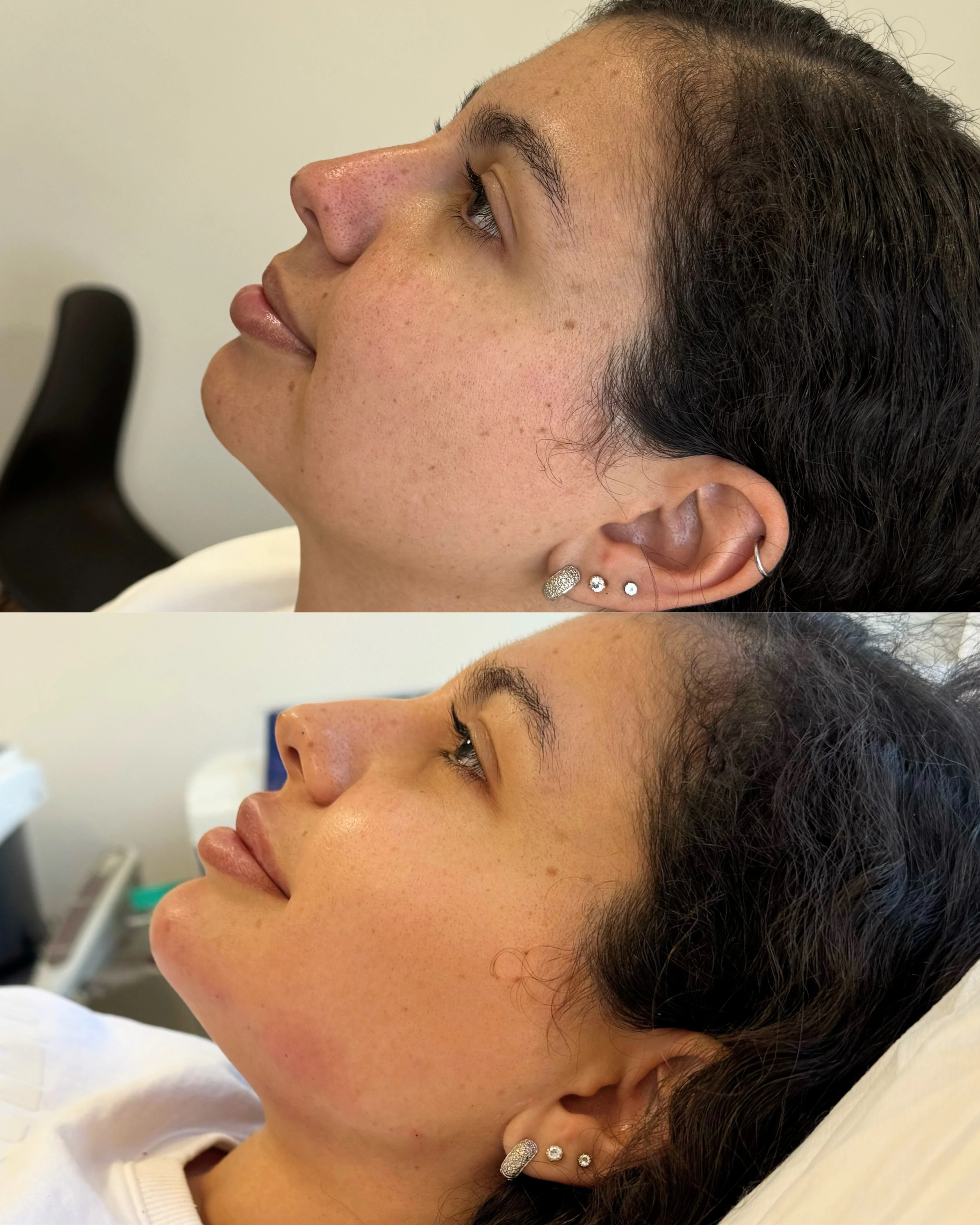 Resultado Perfiloplastia