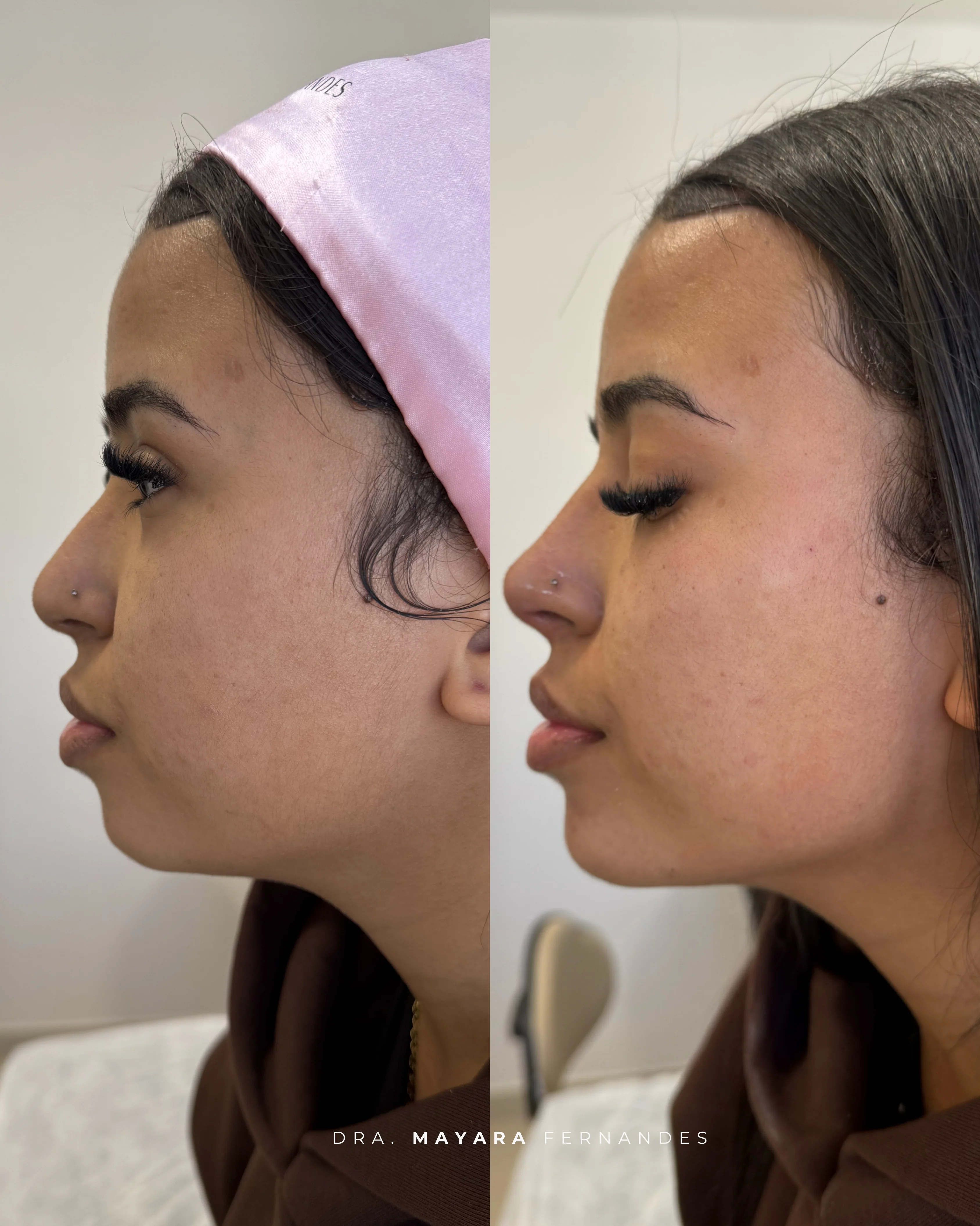 Perfiloplastia