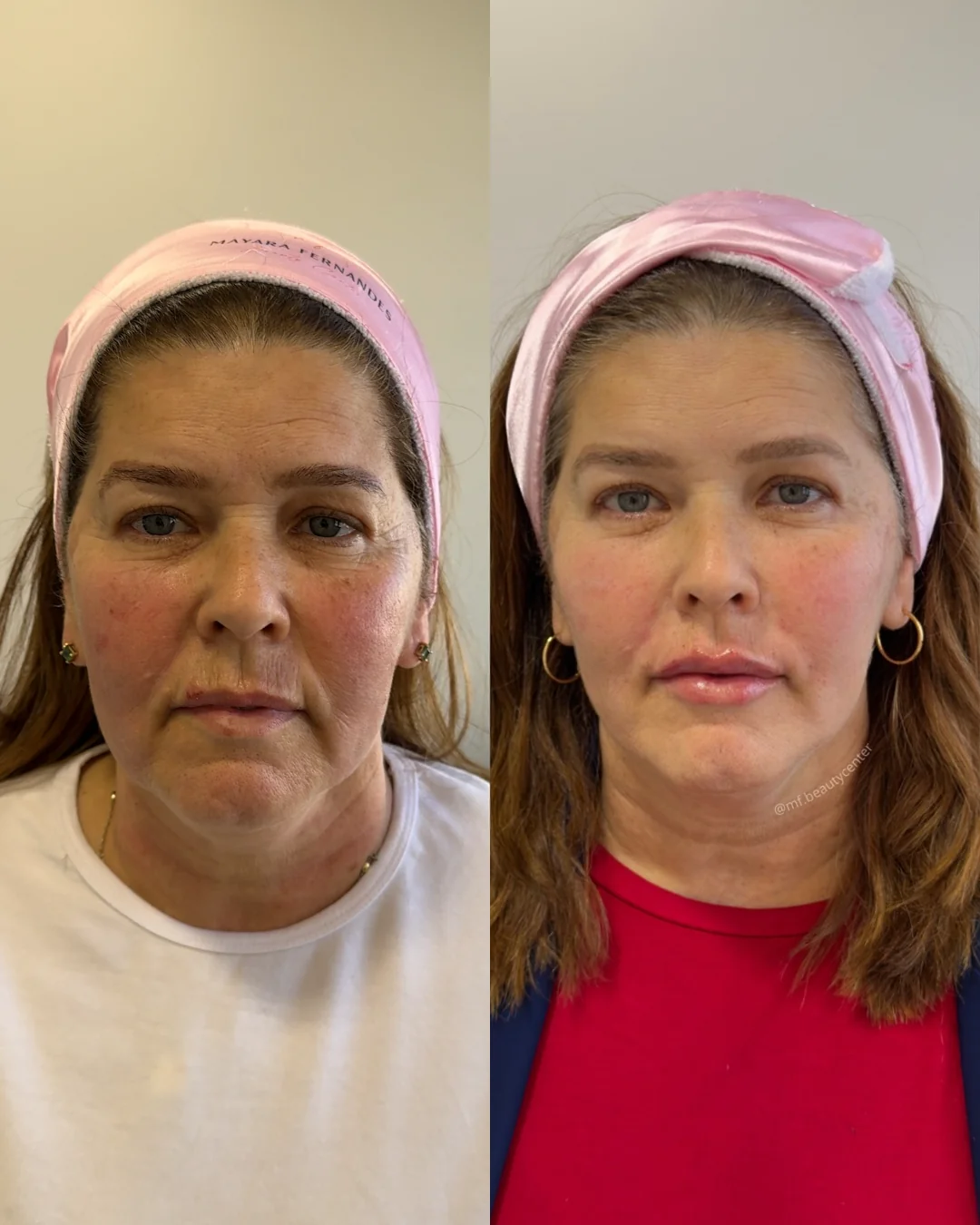 Resultado Ultra Face Lift