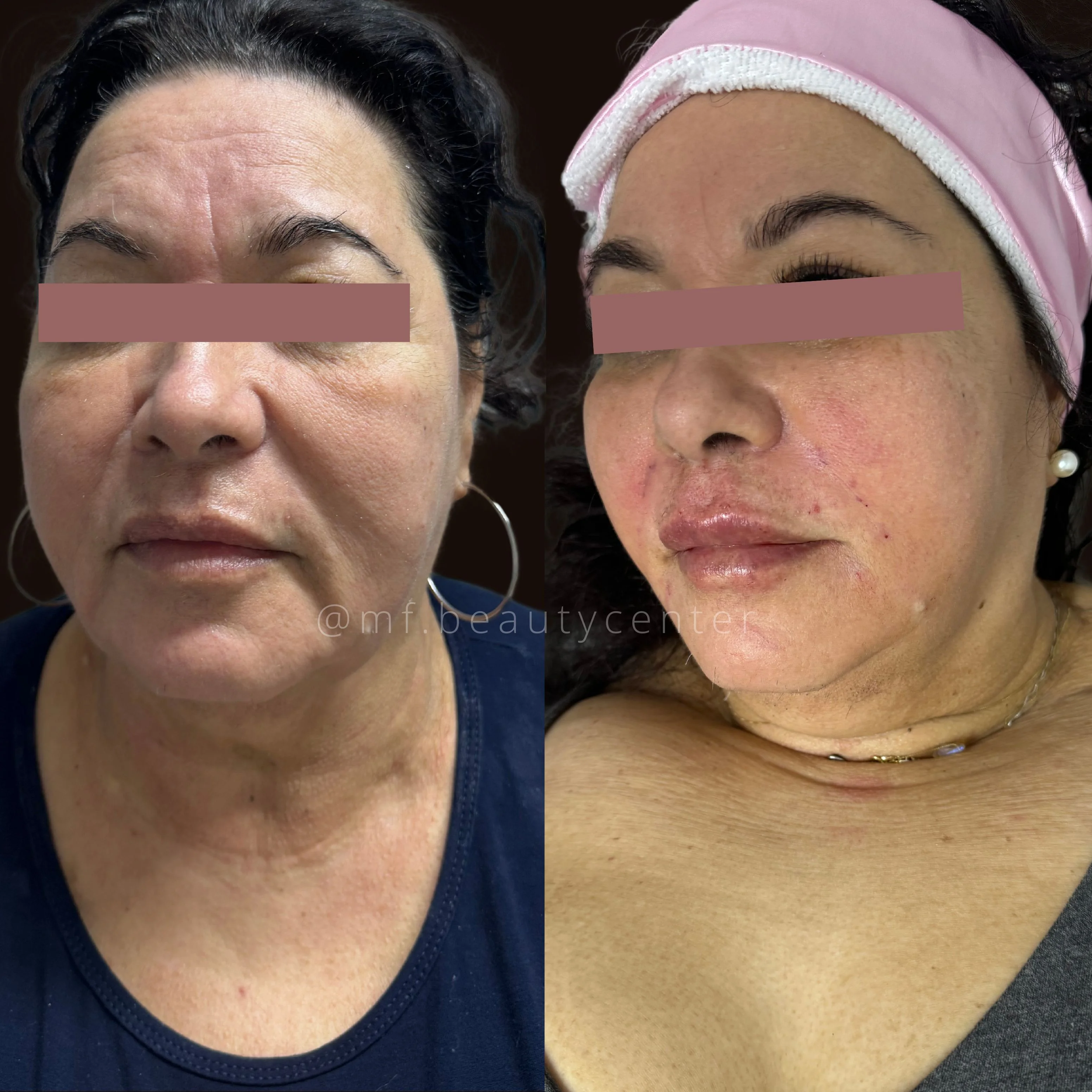 Resultado Ultra Face Lift