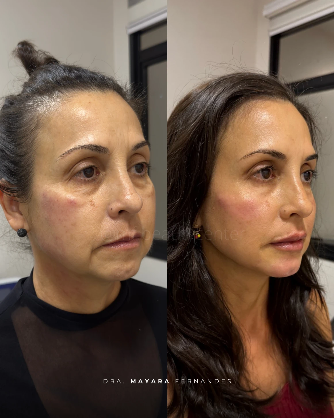 Resultado Ultraface Lift