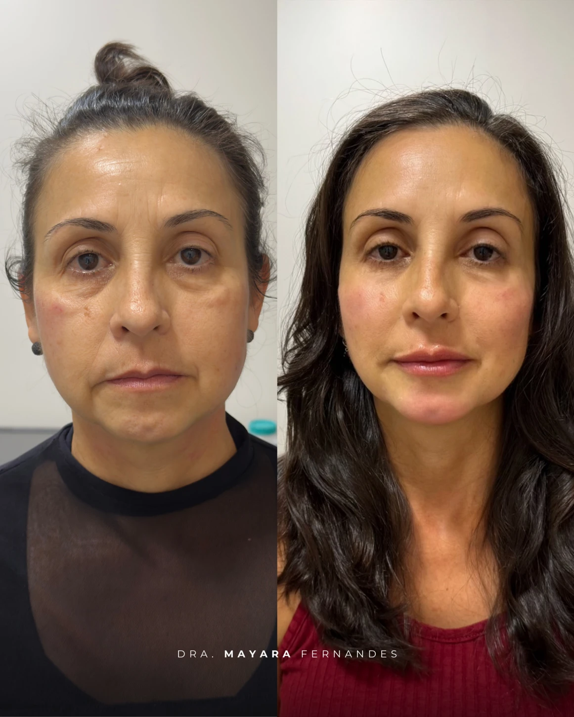Resultado Ultraface Lift