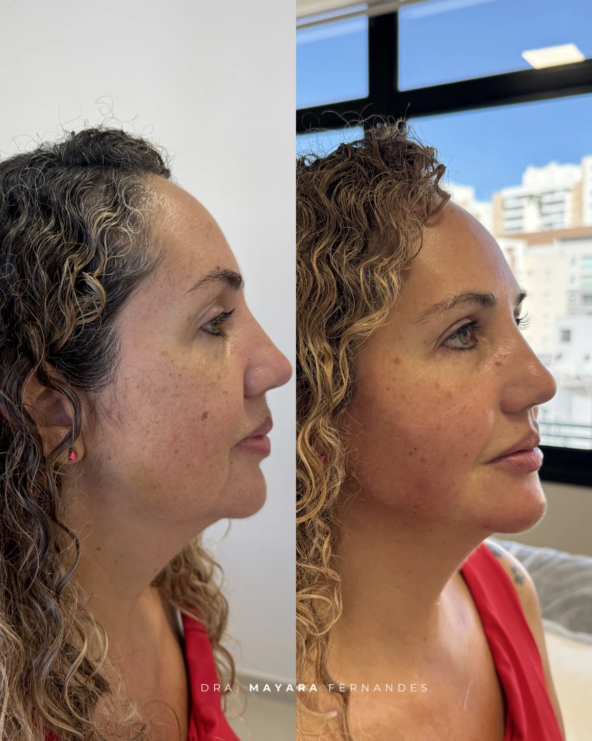 Resultado Ultraface Lift