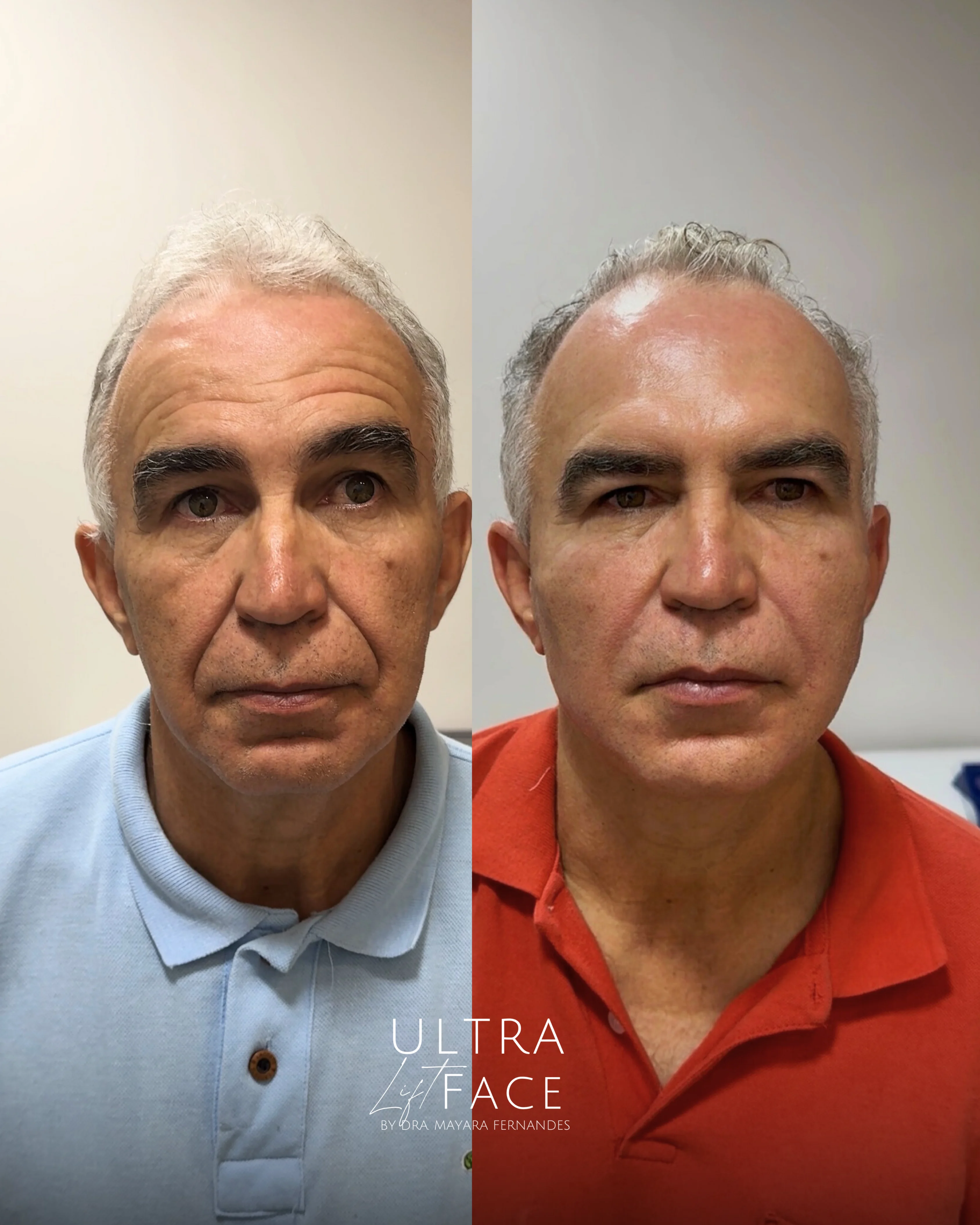 Ultra Face Lifting